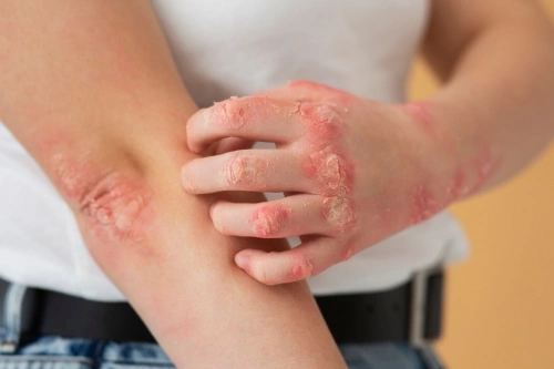 Psoriasis Treatment