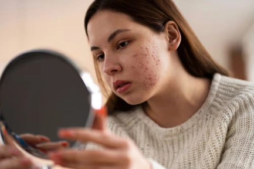 acne scars