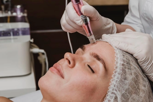 dermapen treatment