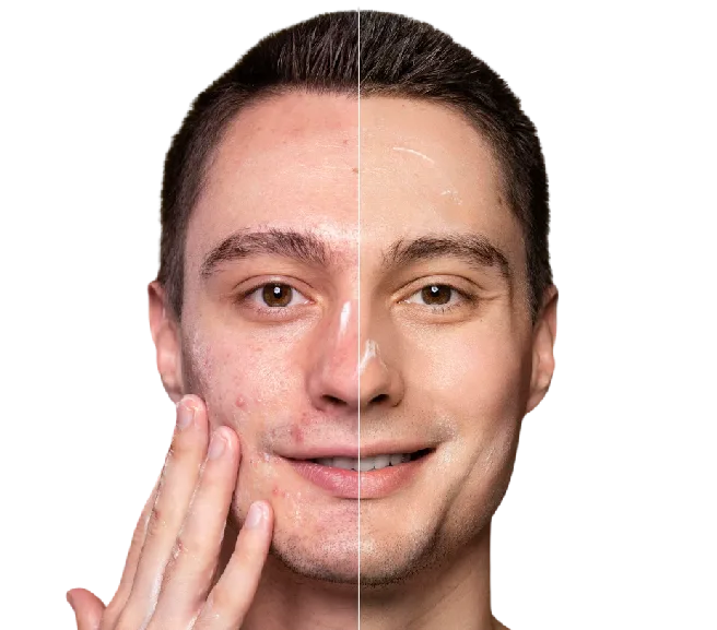 Acne Scars Treatment