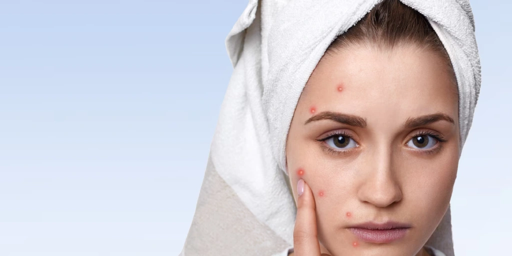 Skincare Routine to Prevent Acne Breakouts
