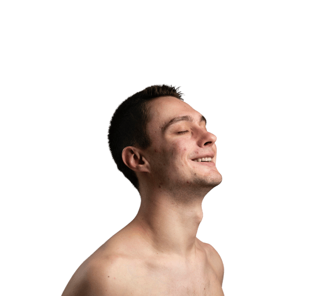 Open Pores Treatment in Noida