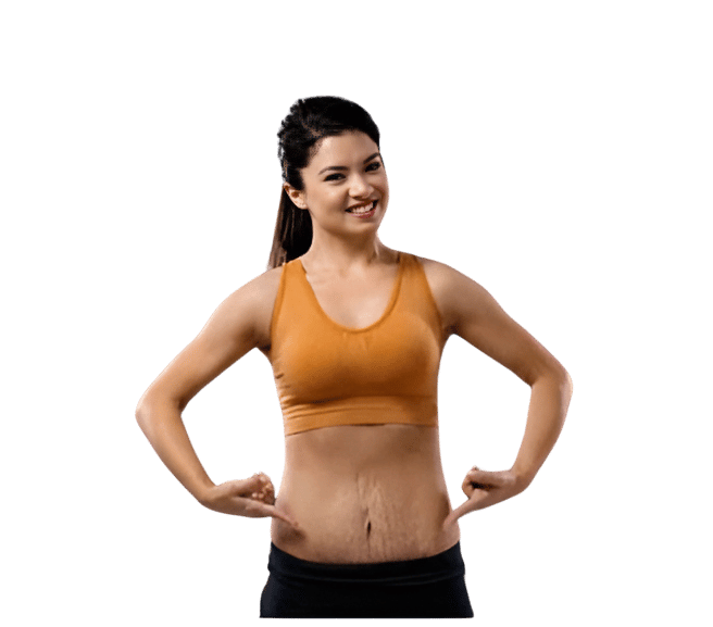 Stretch Marks Removal