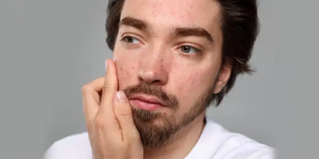 What Causes Adult Acne & How to Treat It?